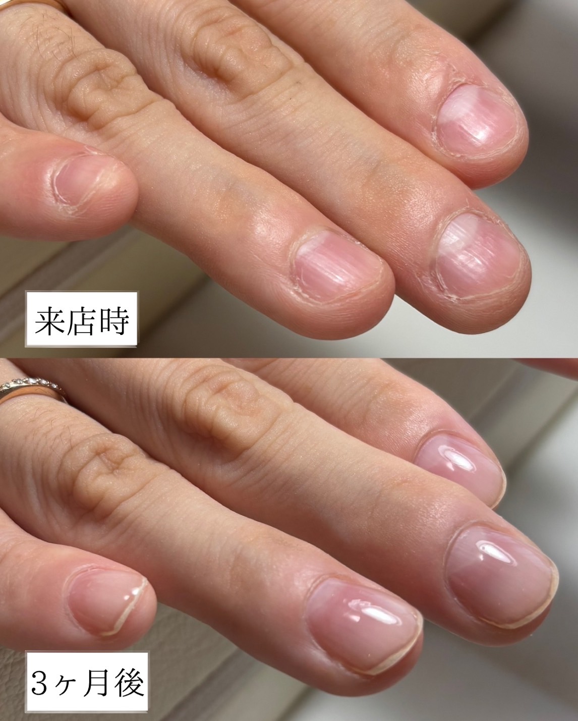 U-nail