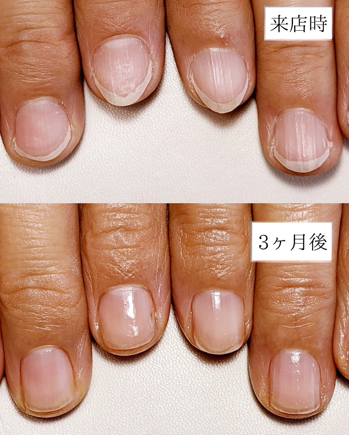 U-nail